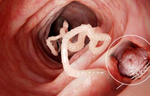 черв'як паразит в організмі людини